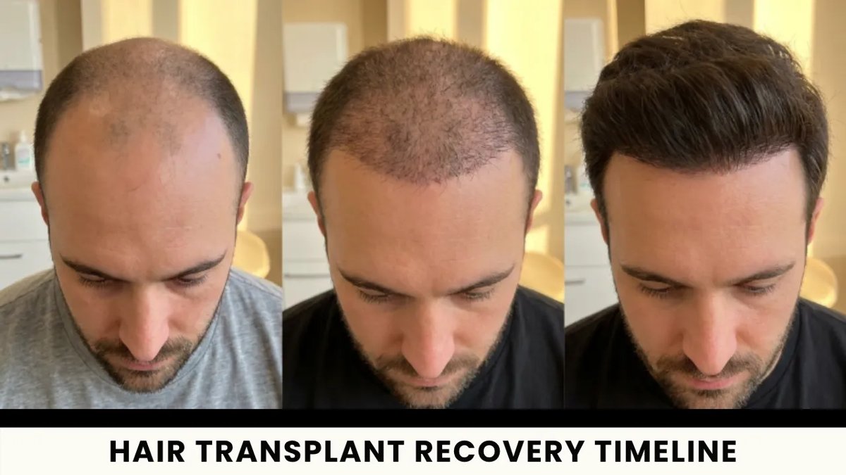 McConaughey hair transplant